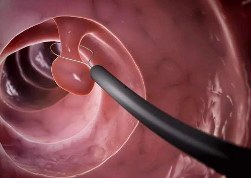 肠镜检查视频,直观呈现肠道健康状态